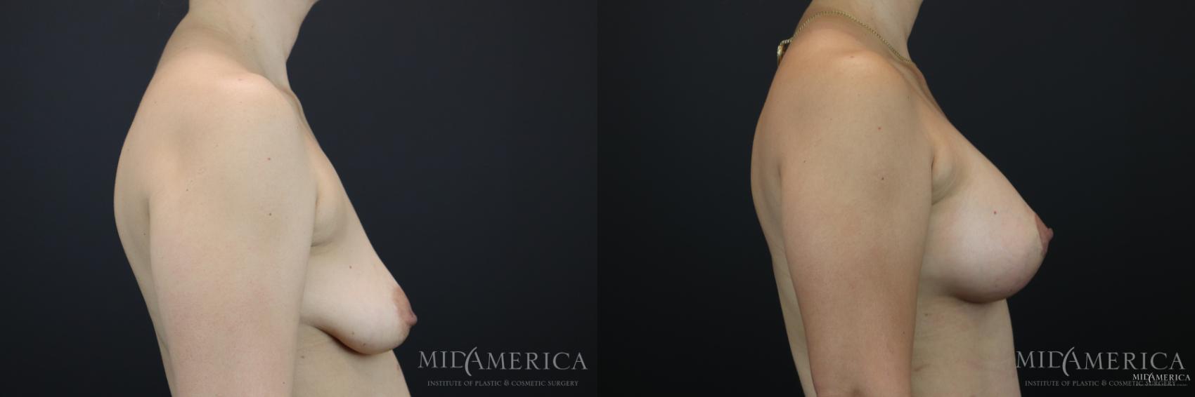 Before & After Breast Lift Case 168 View #5 View in Glen Carbon, IL