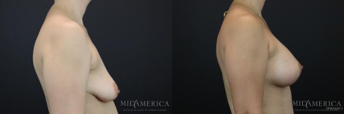 Before & After Breast Lift Case 168 View #5 View in St. Louis, MO