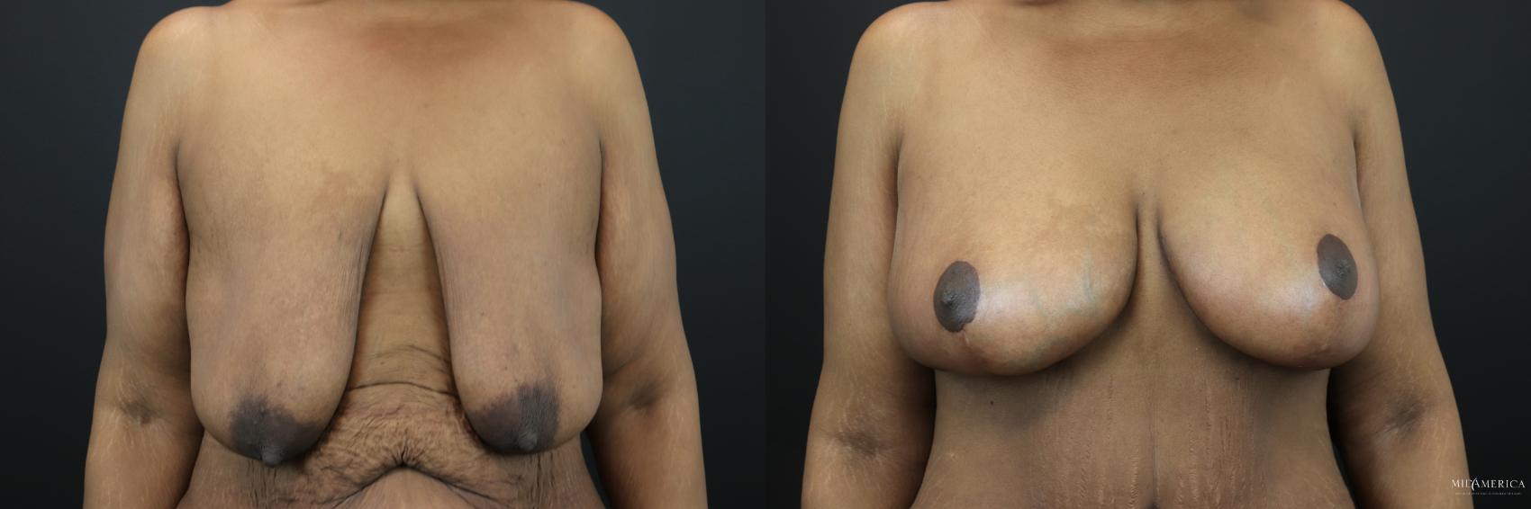 Before & After Breast Lift Case 200 Front View in St. Louis, MO