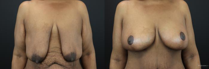 Before & After Breast Lift Case 200 Front View in St. Louis, MO