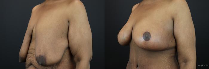 Before & After Breast Lift Case 200 Left Oblique View in St. Louis, MO