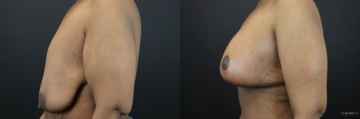 Before & After Breast Lift Case 200 Left Side View in St. Louis, MO