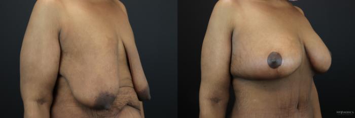 Before & After Breast Lift Case 200 Right Oblique View in St. Louis, MO