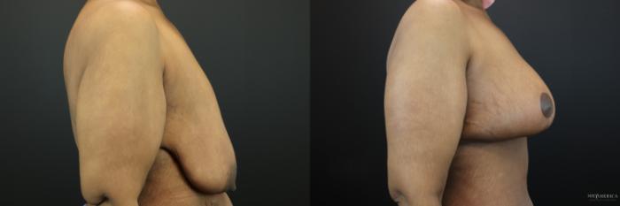 Before & After Breast Lift Case 200 Right Side View in St. Louis, MO