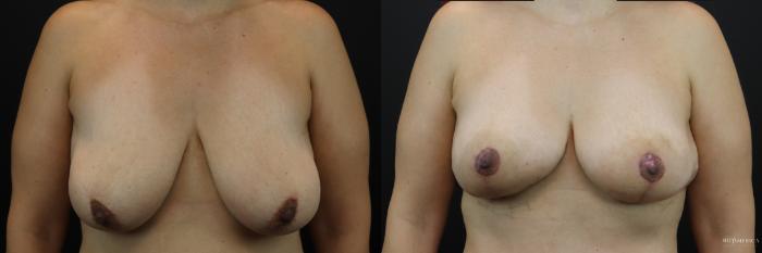 Before & After Breast Lift Case 206 Front View in St. Louis, MO
