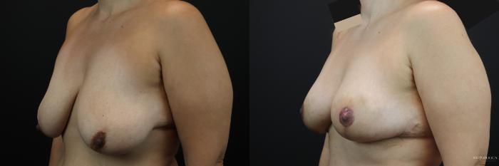 Before & After Breast Lift Case 206 Left Oblique View in St. Louis, MO