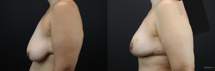 Before & After Breast Lift Case 206 Left Side View in St. Louis, MO