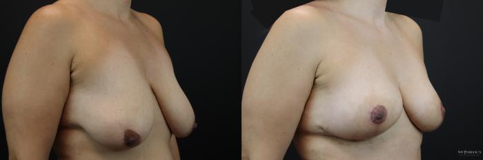 Before & After Breast Lift Case 206 Right Oblique View in St. Louis, MO