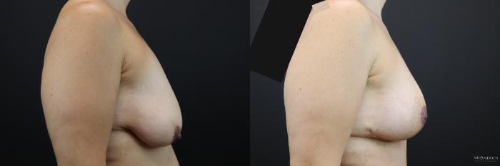Before & After Breast Lift Case 206 Right Side View in St. Louis, MO