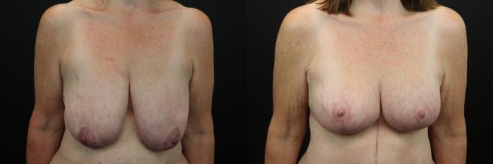 Before & After Breast Lift Case 209 Front View in St. Louis, MO