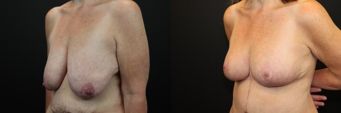 Before & After Breast Lift Case 209 Left Oblique View in St. Louis, MO