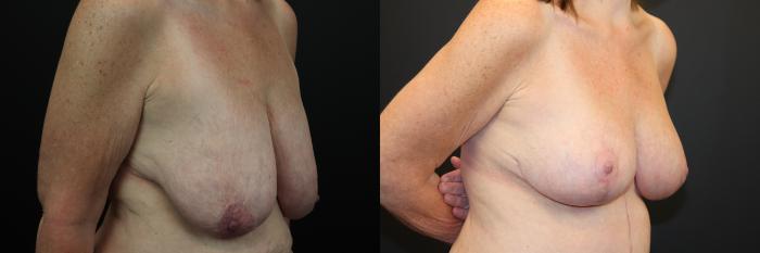 Before & After Breast Lift Case 209 Right Oblique View in St. Louis, MO