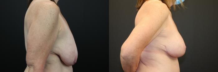 Before & After Breast Lift Case 209 Right Side View in St. Louis, MO