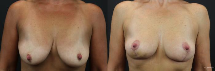 Before & After Breast Lift Case 219 Front View in St. Louis, MO