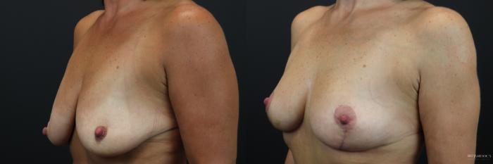 Before & After Breast Lift Case 219 Left Oblique View in St. Louis, MO