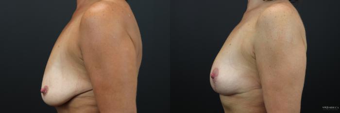Before & After Breast Lift Case 219 Left Side View in St. Louis, MO