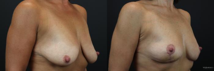 Before & After Breast Lift Case 219 Right Oblique View in St. Louis, MO