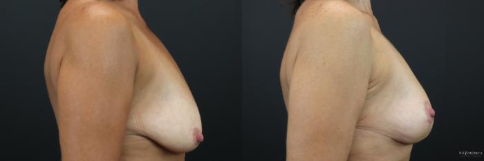 Before & After Breast Lift Case 219 Right Side View in St. Louis, MO