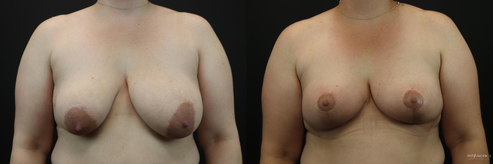 Before & After Breast Lift Case 250 Front View in Glen Carbon, IL