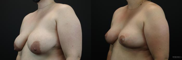 Before & After Breast Lift Case 250 Left Oblique View in Glen Carbon, IL