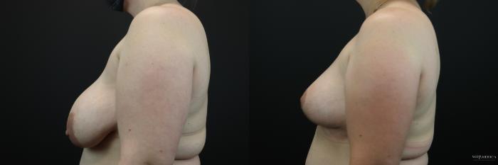 Before & After Breast Lift Case 250 Left Side View in Glen Carbon, IL