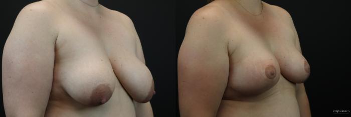 Before & After Breast Lift Case 250 Right Oblique View in Glen Carbon, IL