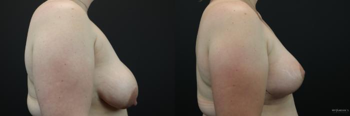 Before & After Breast Lift Case 250 Right Side View in Glen Carbon, IL