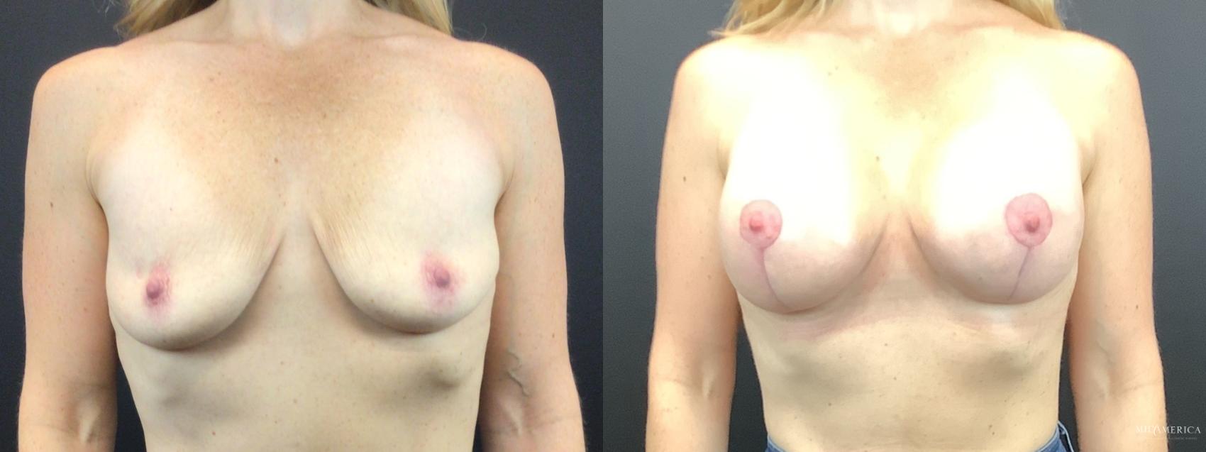 Before & After Breast Lift Case 275 Front View in St. Louis, MO