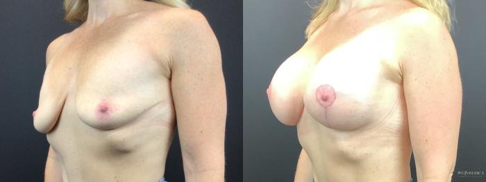 Before & After Breast Lift Case 275 Left Oblique View in St. Louis, MO