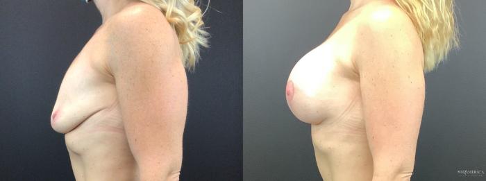 Before & After Breast Lift Case 275 Left Side View in St. Louis, MO