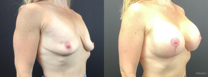 Before & After Breast Lift Case 275 Right Oblique View in St. Louis, MO