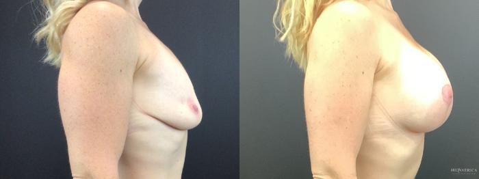 Before & After Breast Lift Case 275 Right Side View in St. Louis, MO