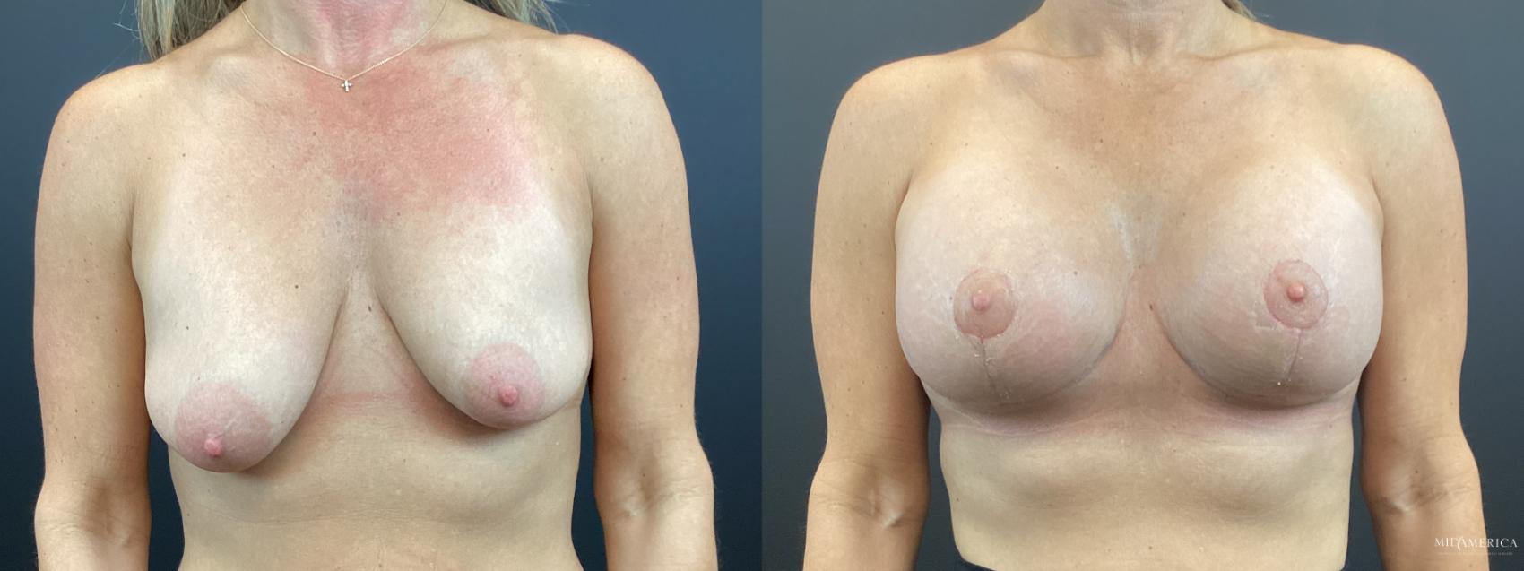 Before & After Breast Lift Case 320 Front View in St. Louis, MO