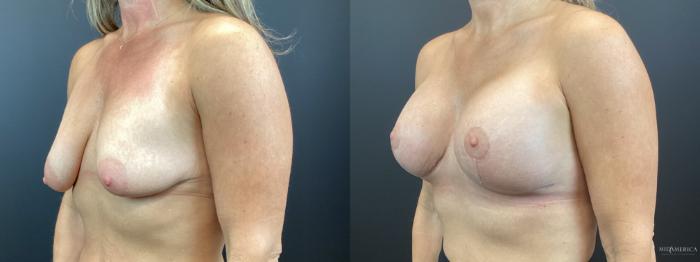 Before & After Breast Lift Case 320 Left Oblique View in St. Louis, MO