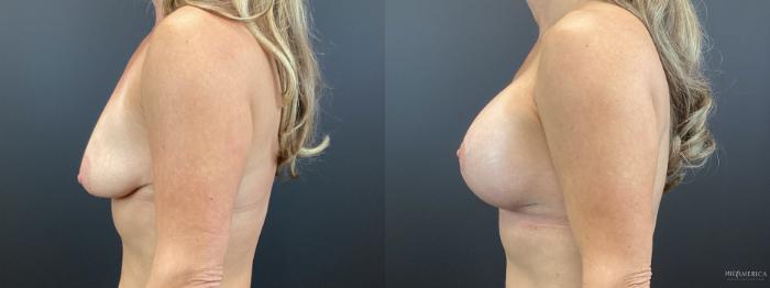 Before & After Breast Lift Case 320 Left Side View in St. Louis, MO