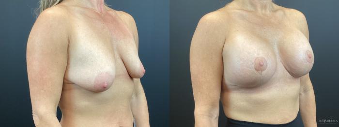 Before & After Breast Lift Case 320 Right Oblique View in St. Louis, MO