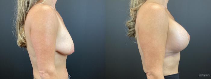 Before & After Breast Lift Case 320 Right Side View in St. Louis, MO