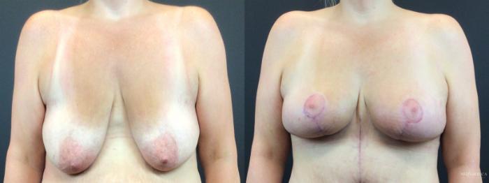 Before & After Breast Lift Case 325 Front View in Glen Carbon, IL