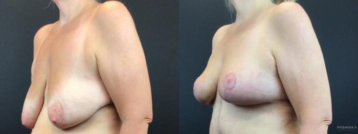 Before & After Breast Lift Case 325 Left Oblique View in St. Louis, MO