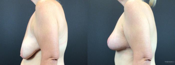 Before & After Breast Lift Case 325 Left Side View in St. Louis, MO