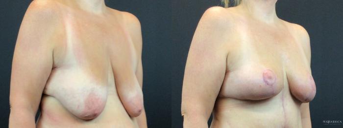 Before & After Breast Lift Case 325 Right Oblique View in St. Louis, MO