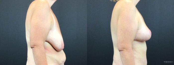 Before & After Breast Lift Case 325 Right Side View in St. Louis, MO