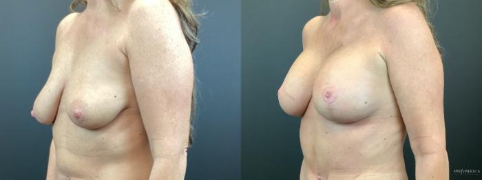 Before & After Breast Lift Case 329 Left Oblique View in St. Louis, MO