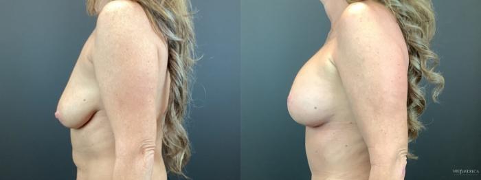 Before & After Breast Lift Case 329 Left Side View in St. Louis, MO