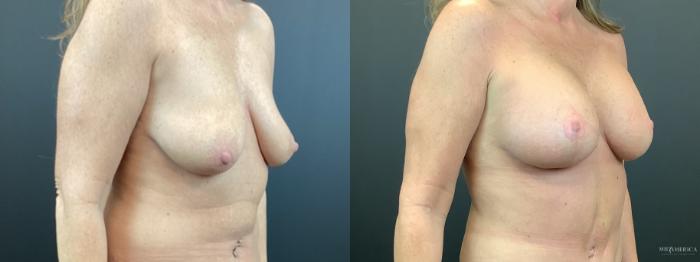 Before & After Breast Lift Case 329 Right Oblique View in St. Louis, MO