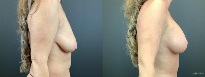 Before & After Breast Lift Case 329 Right Side View in St. Louis, MO