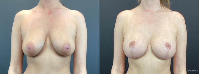 Before & After Breast Lift Case 330 Front View in Glen Carbon, IL