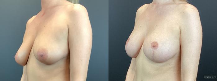 Before & After Breast Lift Case 330 Left Oblique View in St. Louis, MO