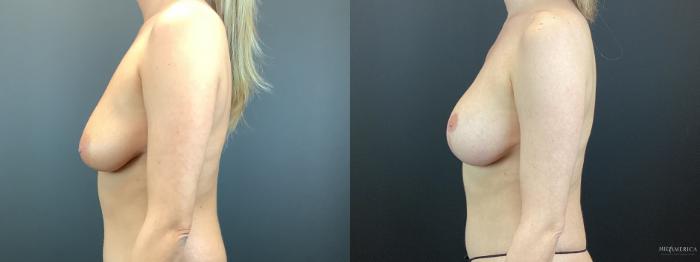 Before & After Breast Lift Case 330 Left Side View in St. Louis, MO