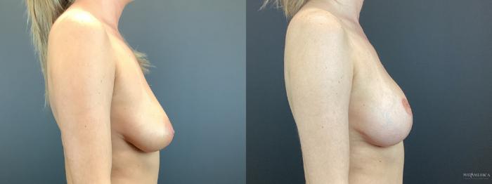 Before & After Breast Lift Case 330 Right Side View in St. Louis, MO
